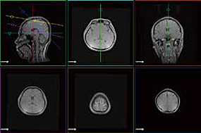 MRI