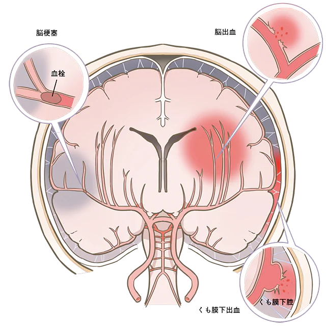 脳血管障害によるもの