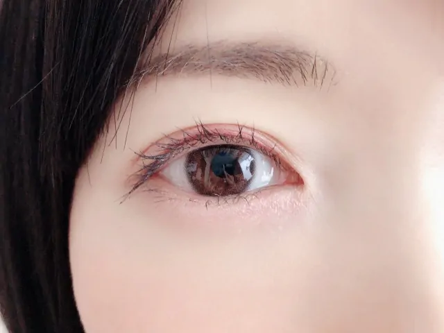 眼瞼痙攣