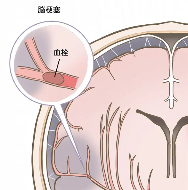 ★大人気商品★ 脳血管障害の検査・予防・治療なら、脳と神経のクリニック橋本 健康・医学